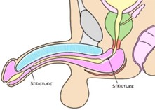 Anatomical diagram showing urethral stricture in male urinary system